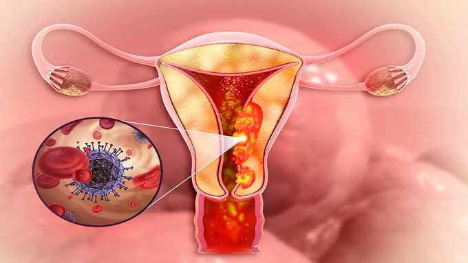 Early symptoms of 4 cancers that affect women.. Don't ignore it..!-oneindia news