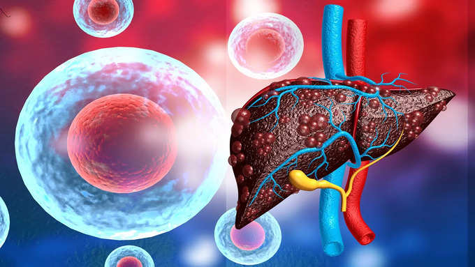 How to diagnose grade 1 fatty liver, what are the treatment methods..?-oneindia news