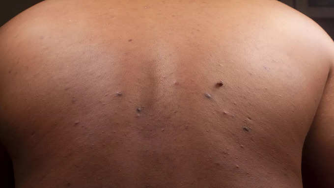 Black spot on the skin.. Will it come after aging?  Will the sun come out?  What is the need for treatment?-oneindia news